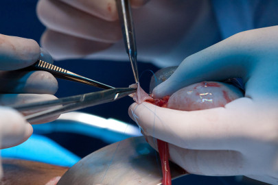 Médicos del Seguro Social realizan transplantes renales en 72 horas