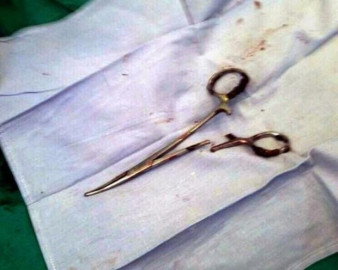 Extraen tijeras olvidadas de hace 18 años en el estómago de un hombre