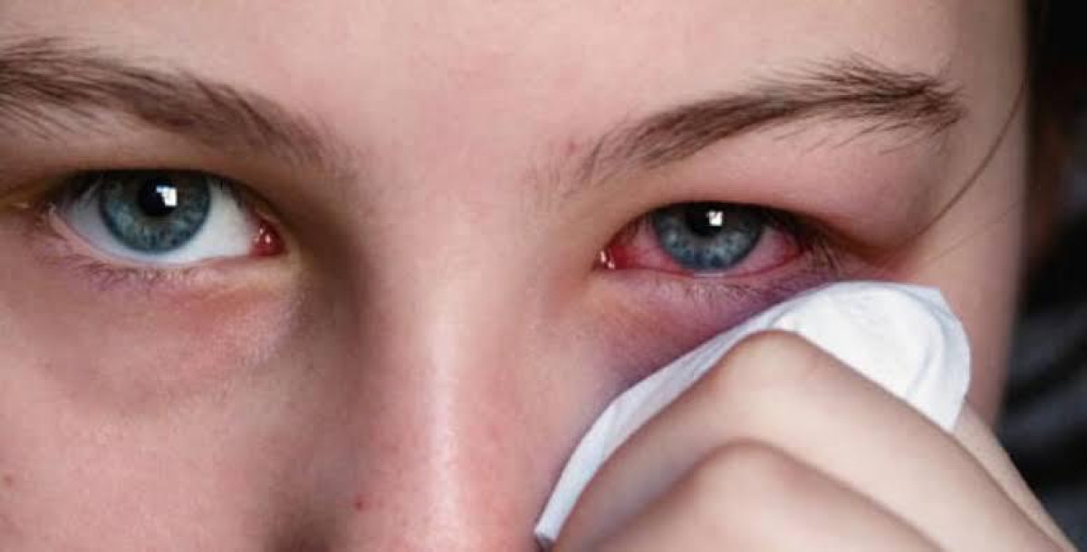 Temen médicos propagación de la conjuntivitis en Matamoros 