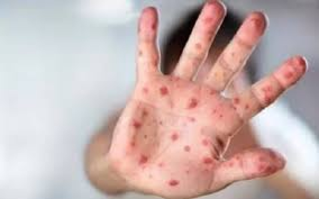 Alerta en norte de Veracruz por Brote de Sarampión en el Sur de Tamaulipas