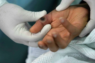 Condado de Hidalgo reporta 2 casos más de viruela símica 